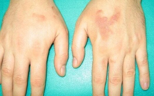 A dor nas articulacións das mans pode ser síntomas de parasitos