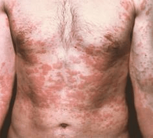 A pel problemática é un síntoma da presenza de parasitos