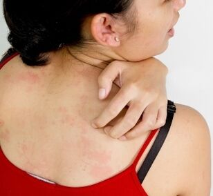 Granulomas no corpo - síntomas da presenza de parasitos