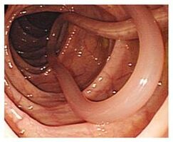 Parasitos no corpo humano