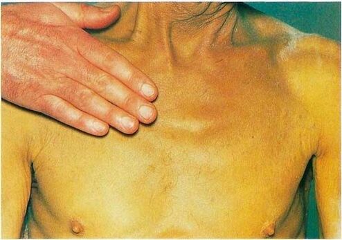 Ictericia debido a parasitos no corpo