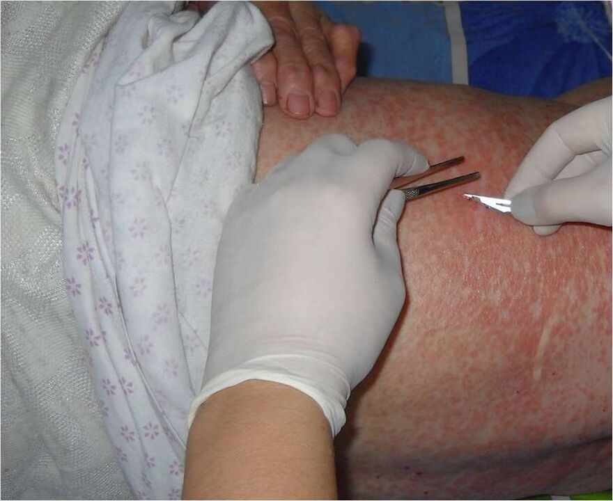 Raspado da zona afectada para detectar parasitos baixo a pel